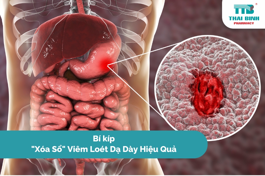Bí Kíp "Xóa Sổ" Viêm Loét Dạ Dày Hiệu Quả