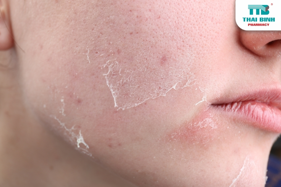 Bí Quyết Cải Thiện Tình Trạng Da Khô Nứt Nẻ Vào Mùa Đông