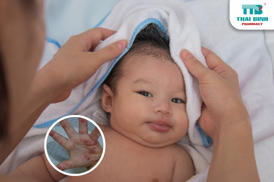 Cách Nhanh Hết Tay Chân Miệng Giúp Trẻ Mau Hồi Phục