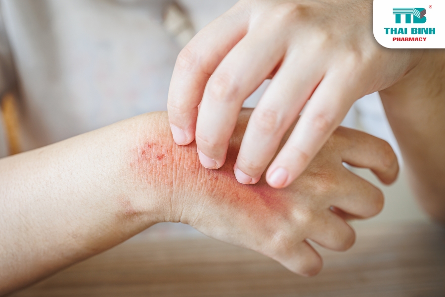 Dị Ứng Da Trong Mùa Hè Và Những Điều Cần Lưu Ý