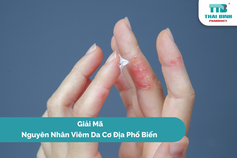 Giải Mã Nguyên Nhân Viêm Da Cơ Địa Phổ Biến