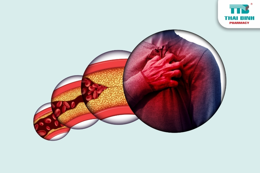 Hiểu Rõ Nhồi Máu Cơ Tim Để Nhận Biết Dấu Hiệu Sớm