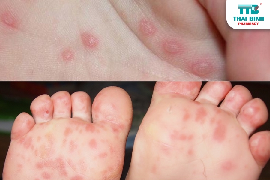 meo-cham-soc-tre-mac-tay-chan-mieng-tai-nha-chuan-y-khoa