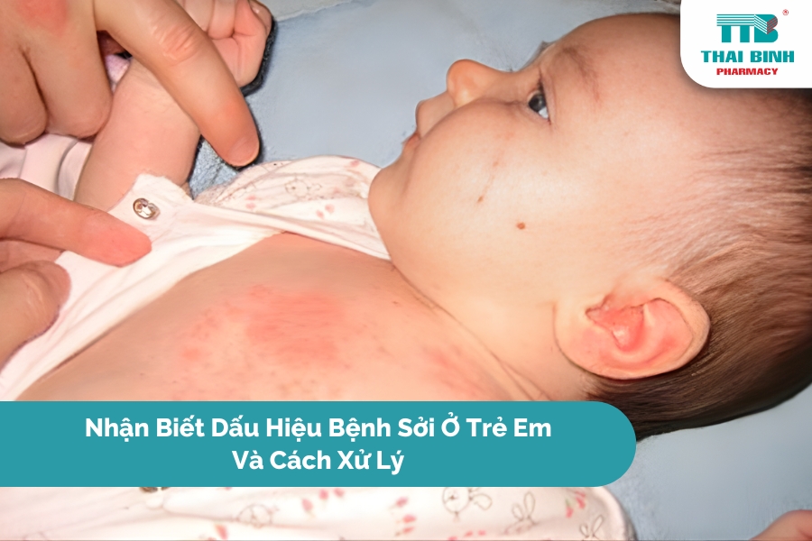 Nhận Biết Dấu Hiệu Bệnh Sởi Ở Trẻ Em Và Cách Xử Lý