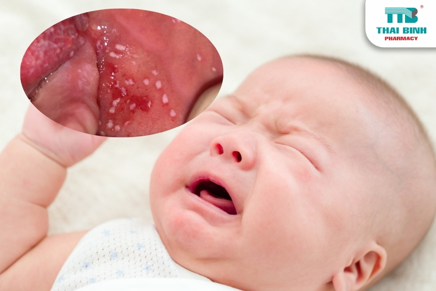 Nhận Biết Dấu Hiệu Bệnh Sởi Ở Trẻ Em Và Cách Xử Lý