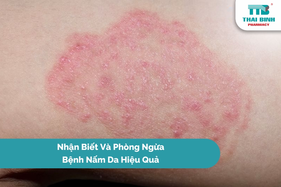 Nhận Biết Và Phòng Ngừa Bệnh Nấm Da Hiệu Quả
