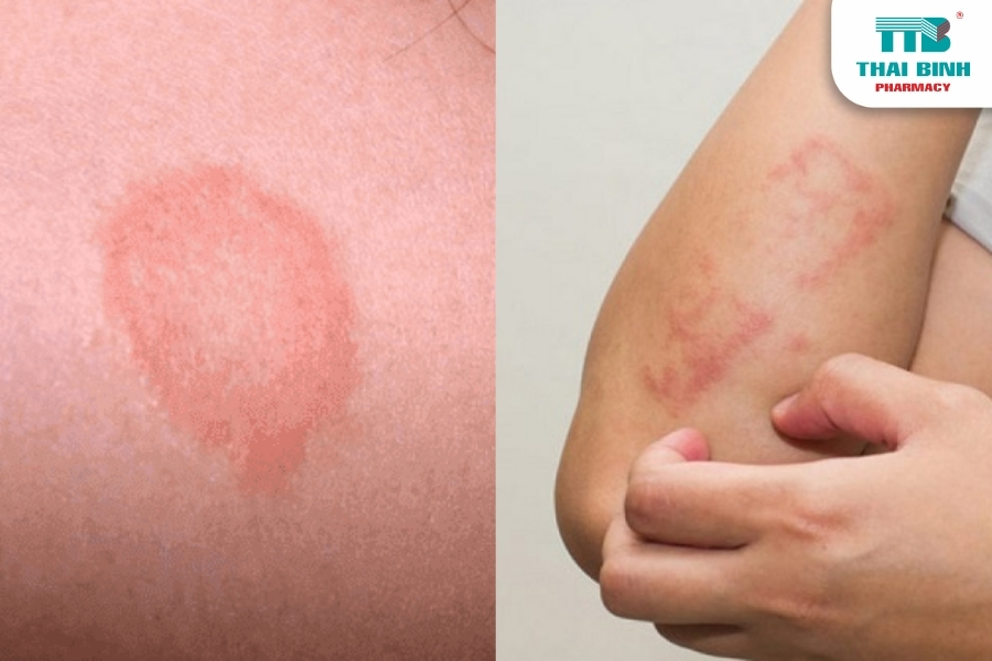 Nhận Biết Và Phòng Ngừa Bệnh Nấm Da Hiệu Quả