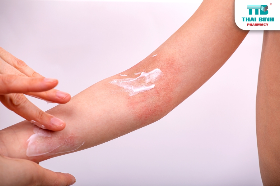 Những Điều Mẹ Cần Biết: Viêm Da Cơ Địa Trẻ Em Và Cách Chăm Sóc Đúng