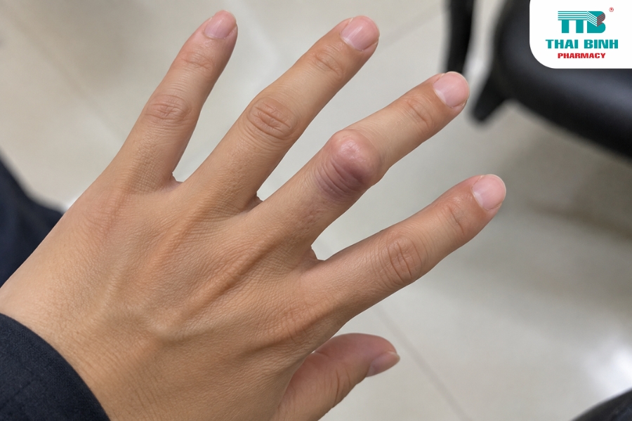 Trật Khớp Ngón Tay Có Nguy Hiểm Không? Xử Trí Thế Nào Cho Đúng?