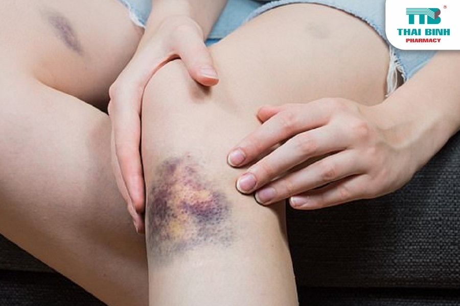 Ung Thư Máu Ở Người Trẻ: Dấu Hiệu Nhận Biết Sớm